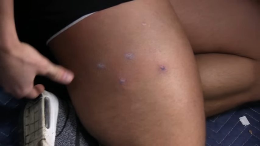 how to treat paintball bruises